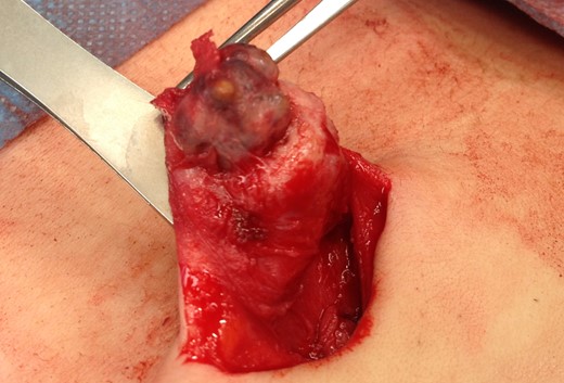 Intraoperative image of dark discoloured, lobulated swelling at the bottom of the umbilicus that turned out to be PUE.