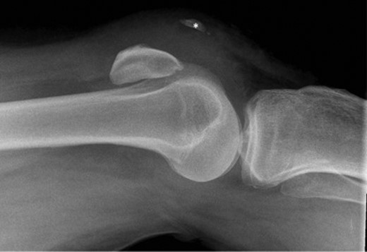 Lateral radiograph of right knee, demonstrating patella alta and ectopic ossification of the patellar tendon (marked *). No evidence of acute fracture.