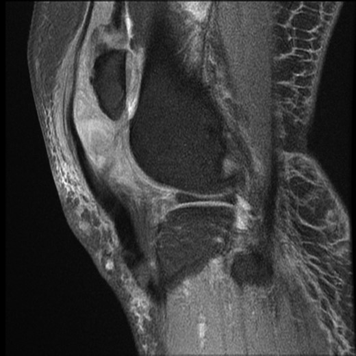 MRI right knee. Sagittal T1 image. Demonstrating rupture patellar tendon attachment from inferior pole of patella, high riding patella, chronic tendinosis of patellar tendon and clustering of sheared quadriceps tendon.