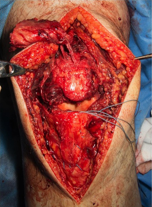 Intra-operative image demonstrating shearing of the quadriceps tendon, complete patellar tendon rupture, and injuries to medial and lateral retinaculum.