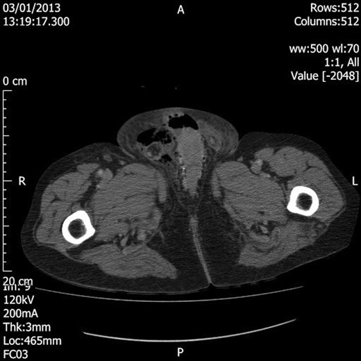Axial section CT image demonstrating loculated air within the right hemiscrotum.