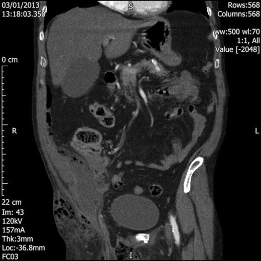 Coronal section CT image demonstrating extension of the loculated air superiorly into the inguinal canal and lower anterior abdominal wall and laterally into the right buttock. There is also a 10 × 4 × 6 cm fluid and air collection in the right pelvis.