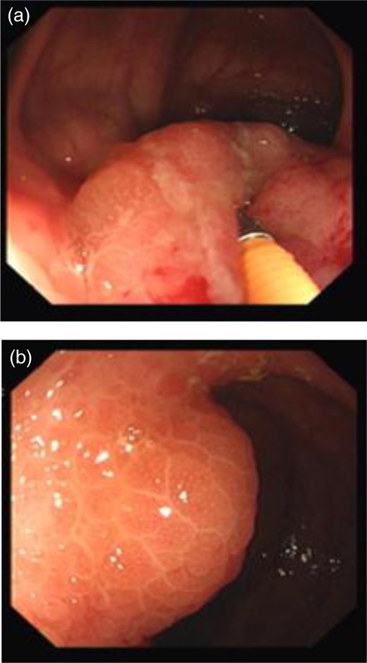 Colonoscopy views showing inflammation in the ICV (a) and TI (b).