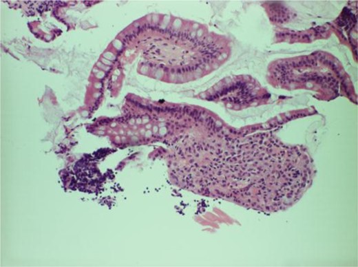 Histology slide of tissue from the ICV showing deposits of lobular breast carcinoma and infiltration of neutrophils into the surface epithelium and lamina propria.