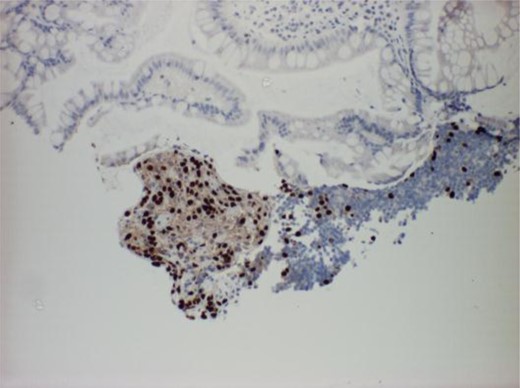 Histology slide showing ER-positive cells from the TI.