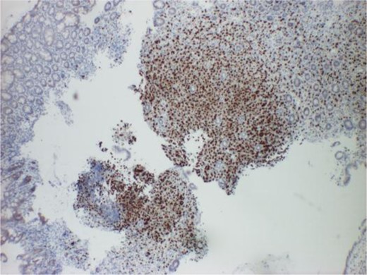 Histology slide showing ER-positive cells from the ICV.
