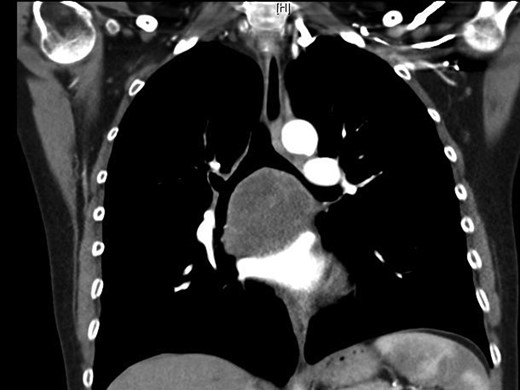 Subcarinal tumor on preoperative CT of the chest, coronal cuts.