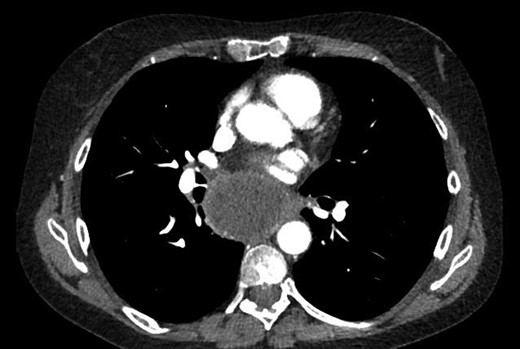 Subcarinal tumor on preoperative CT of the chest, axial cuts.