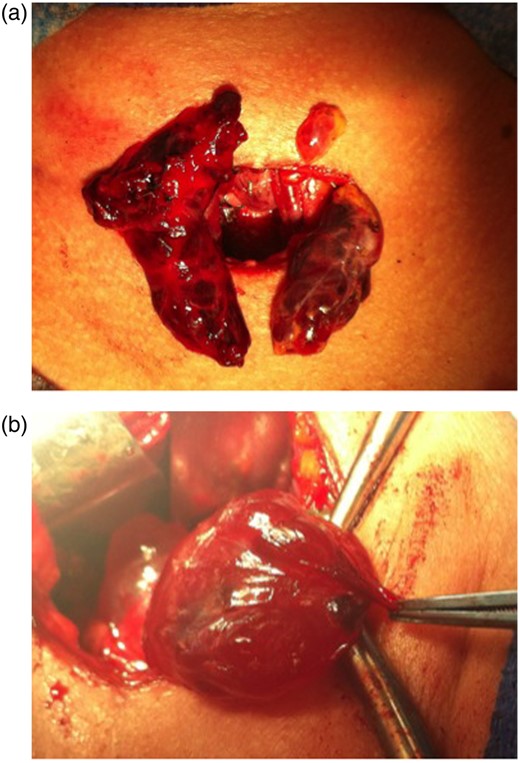 (a) Intraoperative photograph showing cystic parathyroid glands. (b) Cystic parathyroid glands.