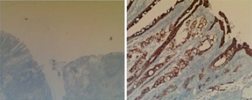 Appendix. CK-7 stain (left) and CK-20 stain (right).