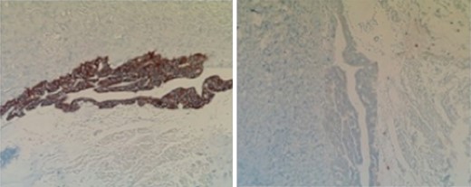 Ovary. CK-7 stain (left) and CK-20 stain (right).