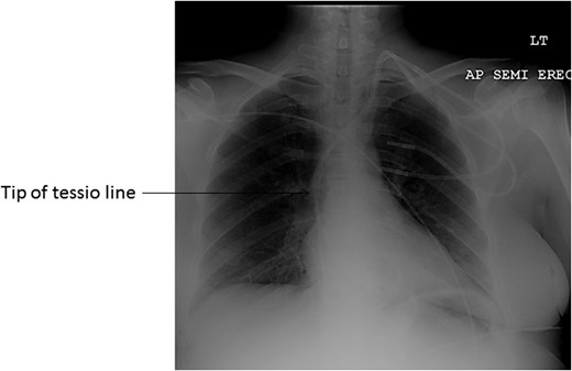 Chest X-ray showing the tip of catheter in the right atrium.