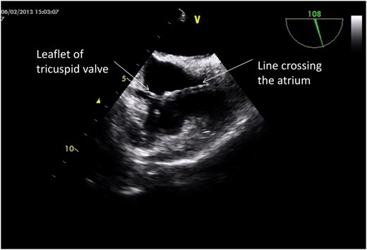 Trans-oesophageal echocardiogram with bicaval view showing the position of the line in relation to the tricuspid valve.