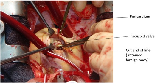 Intra-operative picture showing the position of the line traversing the tricuspid valve.
