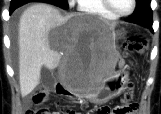 Enhanced CT scan demonstrated a low-density giant mass 13 cm in size and high-density ascites.