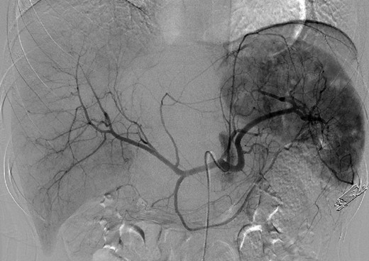 Emergent angiography demonstrated an avascular tumor and did not reveal any extravasation from the hepatic artery.