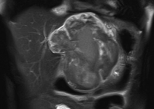 MRI confirmed a well-defined giant multilocular lesion with fibrous partitioning.