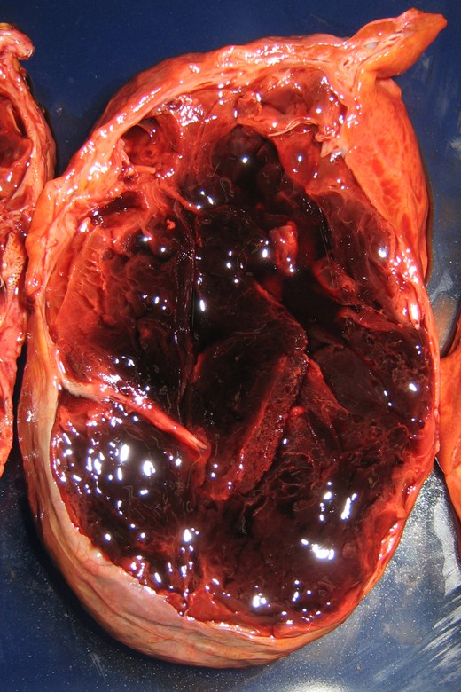 The mass was cystic and multilocular with a fibrous cystic wall and was macroscopically filled with a massive blood clot.