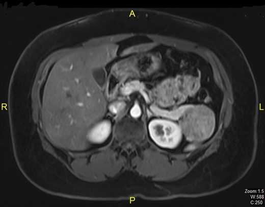 MRI showing lesion at tail of pancreas.
