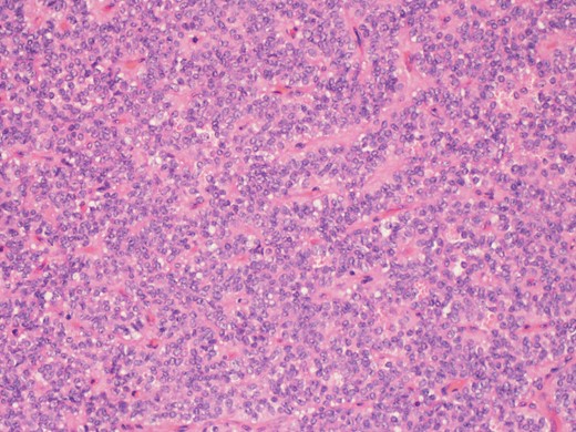 A higher power picture shows the pseudopapillae are lined by layers of bland cells and the nuclei are oval with finely stippled chromatin, nuclear grooves and indistinct nucleoli (H&E ×60).