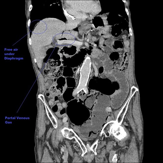 A coronal CT image of the abdomen taken at initial presentation, demonstrating free air under the diaphragm (pneumoperitoneum) and PVG, both marked on images.