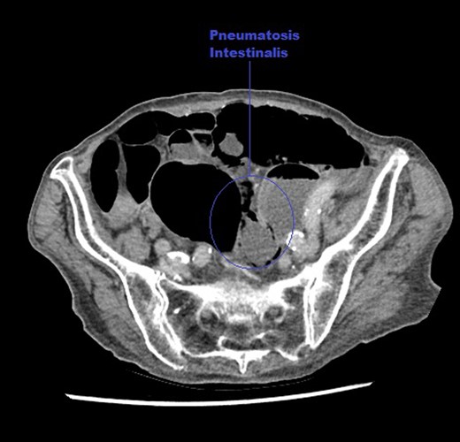 An axial CT image of the abdomen taken at initial presentation, demonstrating PI marked on the image.