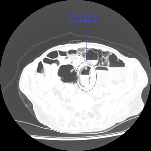 An axial CT image of the pelvis in lung view windows, taken at initial presentation clearly demonstrating intra-mural air within the bowel, marked on image.