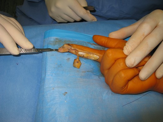 Reverse homodigital artery flap.