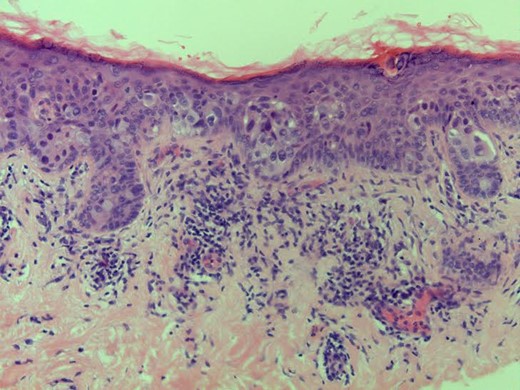 Non-invasive Paget's disease.