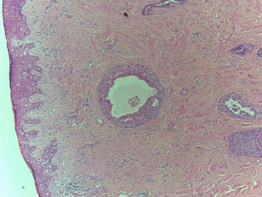 11 mm focus high-grade DCIS solid and micropapillary type.