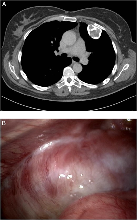 (A) A calcified tumour on the left chest wall growing from the second rib with slight impression of the lung with a maximal diameter of 4.7 cm. (B) Bony tumour originating from the left second and third rib, with some pleural adhesions.