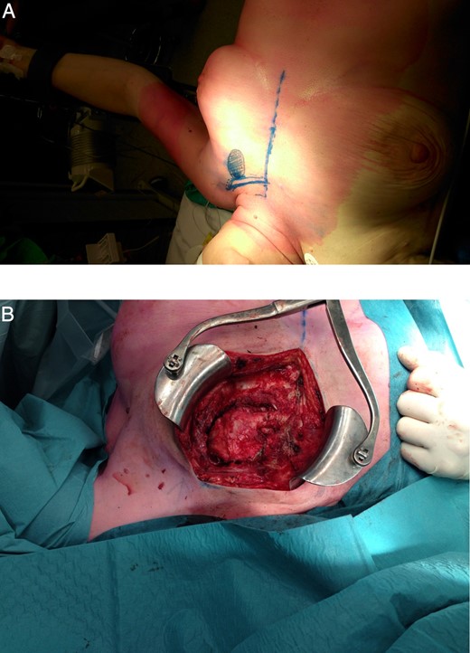 (A) Conversion to thoracotomy. (B) Chest wall defect after resection of the tumour.