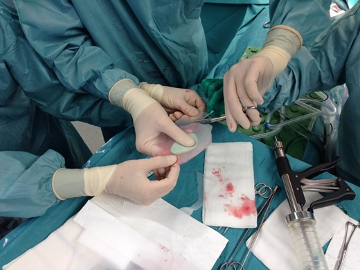 Preparation of the patch with two polypropylene meshes and interpolate of methyl methacrylate.