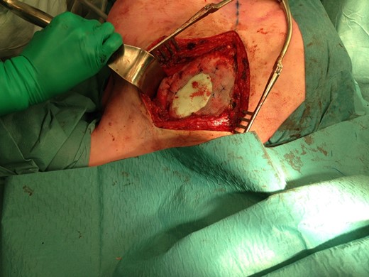 Positioning of the mesh and fixation to the periosteum of adjacent ribs.