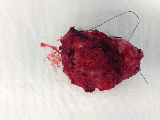 The resected tumour. Marking: short, cranial side; long, lateral side.