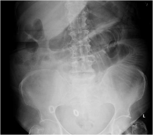 Abdominal radiograph showing dilated small-bowel loops (Case 1).