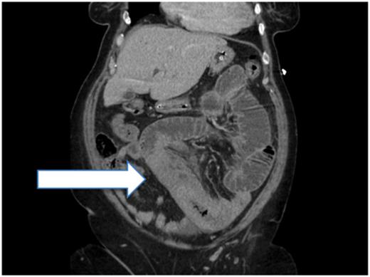 Post-contrast CT (sagittal plane) showing proximal small-bowel dilation and a thickened small-bowel segment (Case 1).