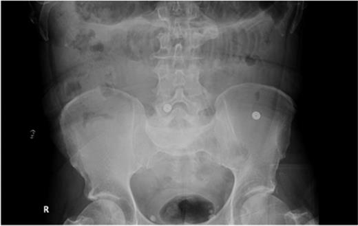 Abdominal radiograph showing dilated small-bowel loops (Case 2).