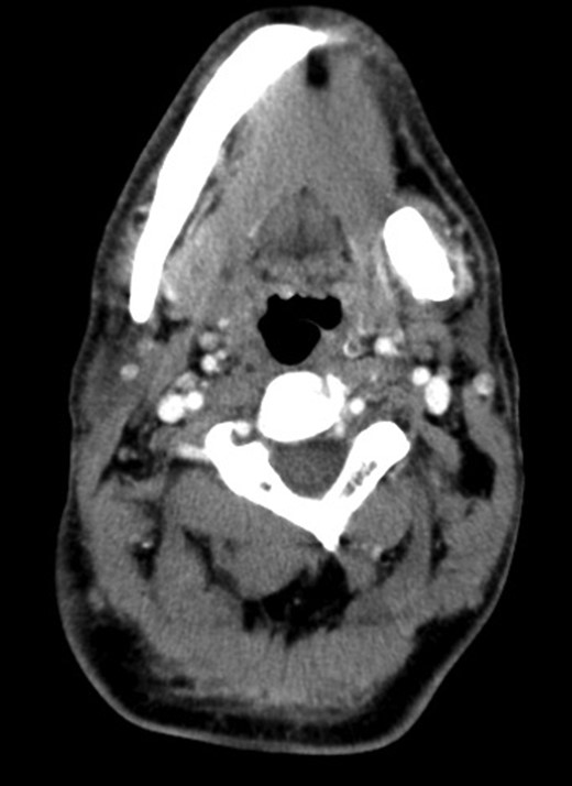 Coronal CT image showing the calcified mass of 42 × 17 mm in the left submandibular gland.