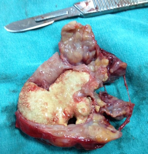 Intraoperative view of the giant sialolith located within the atrophic submandibular gland.