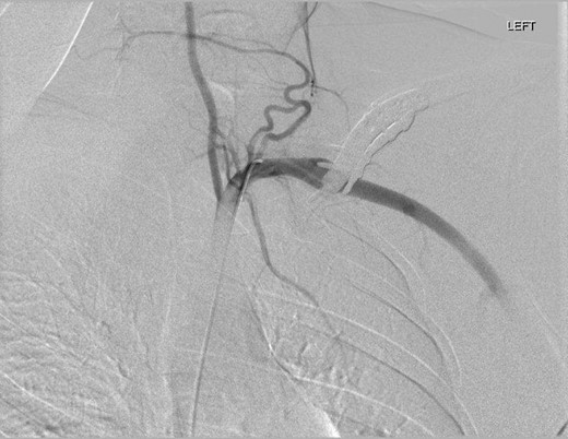 DSA oblique view illustrating fusiform left subclavian pseudoaneurysm.