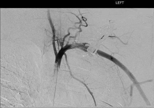 DSA illustrating fusiform left subclavian pseudoaneurysm.