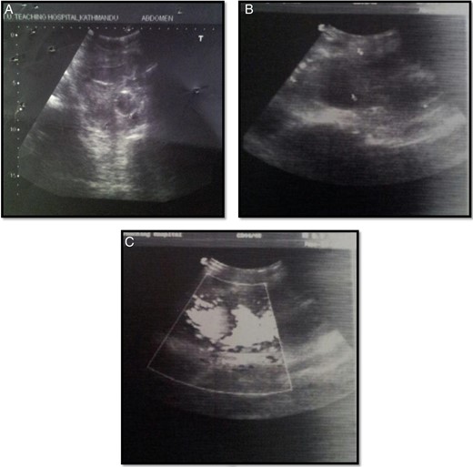 Arterial Doppler pictures: (A) urinary bladder with Foley's in situ and echogenic content likely clots; (B) large solid-cystic pulsatile lesion noted in the right inguinal region; (C) lesion in connection with common femoral artery via wide neck which showed to and fro spectral wave form (classical Ying Yang flow).