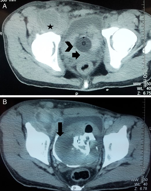 Axial CECT abdomen and pelvis pmages: (A) femoral pseudoaneurysm (marked with star), urinary bladder with clots (arrowhead) and Foley's catheter in situ (arrow); (B) communication between pseudoaneurysm and urinary bladder which was overlooked preoperatively (marked by arrow).