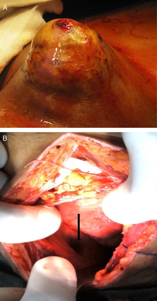 (A) Infected femoral pseudoaneurysm in an IV drug abuser; (B) intraoperative picture showing the communicating rent between pseudoaneurysm and bladder (marked by arrow).