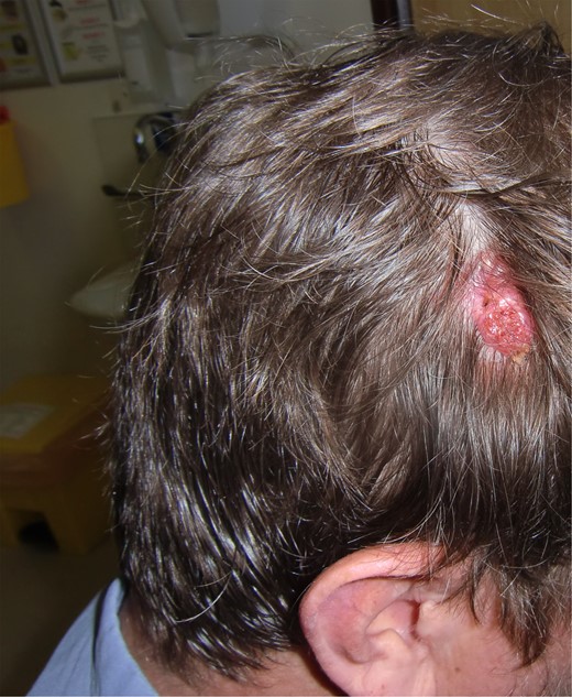 Sebaceous naevus right parietal. Typical waxy appearance within hair-bearing region.