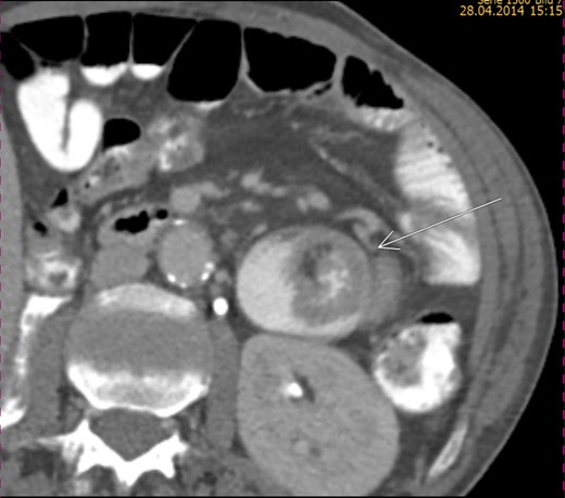 CT scan revealing enhanced masses and jejunal invagination (target sign).