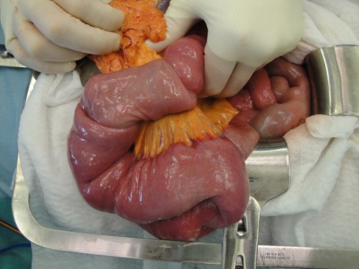 Resected small bowel showing three distinct levels of jejuno-jejunal invagination.