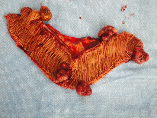 Mucosal surface of the jejunum showing several polypoid masses.