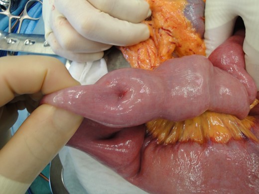 Dimple formation on the serosa due to traction of the tumour.